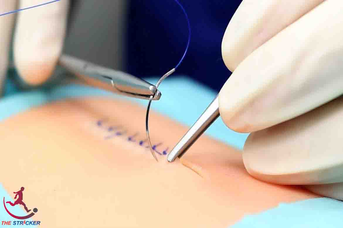 Surgical Suture Innovation of Textile Thread | Innovative Textile |